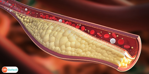 Low-Cost Hypercholesterolemia Treatment in India, Hypercholesterolemia, Familial Hypercholesterolemia, Familial Hypercholesterolemia Diagnosis, Hypercholesterolemia Symptoms, Treatment For Hypercholesterolemia, Heart Surgery Cost In India