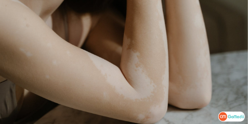 Vitiligo Treatment In Delhi, Vitiligo Surgery Cost In Delhi, Vitiligo Treatment In India, Vitiligo Specialist In Delhi Vitiligo Treatment In Delhi, Vitiligo Surgery Cost In Delhi, Vitiligo Treatment In India, Vitiligo Specialist In Delhi