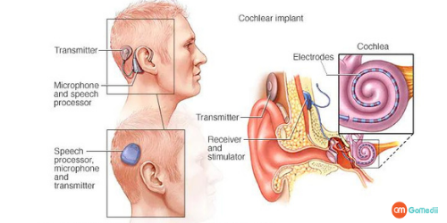 Cochlear Implants In India, Cochlear Implants Surgery In India, Cochlear Implants Cost In India, Cochlear Implants Cost In Delhi, Parts Of Cochlear Implant, Types Of Cochlear Implants