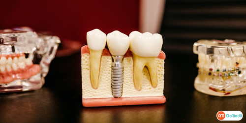  Root Canal Treatment In Lucknow, Root Canal Treatment, stages of root canal treatment, Benefits Of Root Canal Treatment, Root Canal Treatment Hospital In Lucknow
