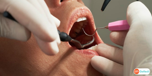  Root Canal Treatment In Lucknow, Root Canal Treatment, stages of root canal treatment, Benefits Of Root Canal Treatment, Root Canal Treatment Hospital In Lucknow