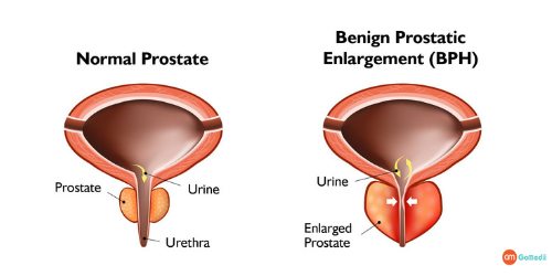  Benign Prostate Treatment Cost In India, Benign Prostate Enlargement Treatment, Prostate Operation Cost In Delhi, Benign Prostate Enlargement Symptoms, Cause Of The Prostate Enlargement