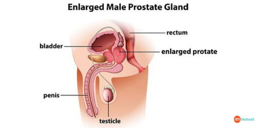  Benign Prostate Treatment Cost In India, Benign Prostate Enlargement Treatment, Prostate Operation Cost In Delhi, Benign Prostate Enlargement Symptoms, Cause Of The Prostate Enlargement