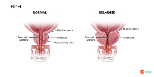  Benign Prostate Treatment Cost In India, Benign Prostate Enlargement Treatment, Prostate Operation Cost In Delhi, Benign Prostate Enlargement Symptoms, Cause Of The Prostate Enlargement