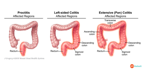 Treatment Of Chronic Ulcerative Colitis In Delhi, Chronic Ulcerative Colitis, Cost Of Chronic Ulcerative Colitis Treatment In Delhi, Chronic Ulcerative Colitis Symptoms In Females, Ulcerative Colitis Treatment Options Treatment Of Chronic Ulcerative Colitis In Delhi, Chronic Ulcerative Colitis, Cost Of Chronic Ulcerative Colitis Treatment In Delhi, Chronic Ulcerative Colitis Symptoms In Females, Ulcerative Colitis Treatment Options