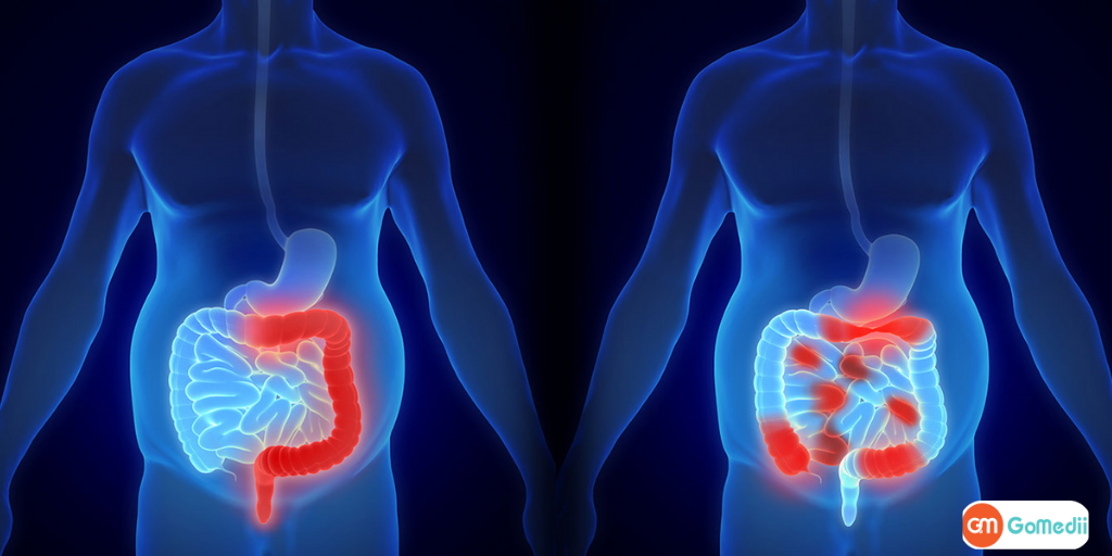Is-chronic-colitis-curable.