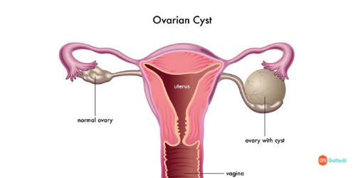 Cambodia Fights Ovarian Cyst, medical journey to India, Ovarian cyst treatment in india, Treatment Partner Cambodia Fights Ovarian Cyst, medical journey to India, Ovarian cyst treatment in india, Treatment Partner