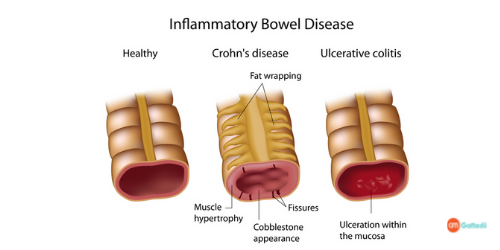 Chronic Active Colitis Treatment Cost in India, Chronic Active Colitis Treatment, Ulcerative colitis Treatment In India, chronic active colitis symptoms, procedure of treatment of Chronic Active Colitis