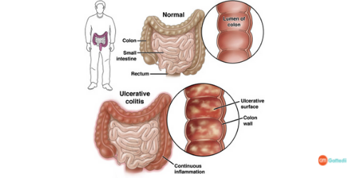 Chronic Active Colitis Treatment Cost in India, Chronic Active Colitis Treatment, Ulcerative colitis Treatment In India, chronic active colitis symptoms, procedure of treatment of Chronic Active Colitis