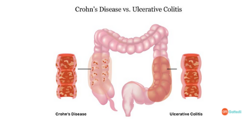 Chronic Active Colitis Treatment Cost in India, Chronic Active Colitis Treatment, Ulcerative colitis Treatment In India, chronic active colitis symptoms, procedure of treatment of Chronic Active Colitis