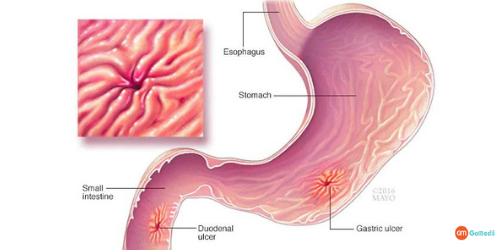 Duodenal Ulcer Treatment In India, Symptom Of Active Duodenal Ulcer, Treatment Cost Of Duodenal Ulcer In India, Active Duodenal Ulcer Treatment Duodenal Ulcer Treatment In India, Symptom Of Active Duodenal Ulcer, Treatment Cost Of Duodenal Ulcer In India, Active Duodenal Ulcer Treatment