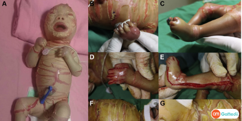 Treatment For Ichthyosis Congenita, types of ichthyosis congenita, life expectancy of someone with ichthyosis, kind of disease is ichthyosis, Is ichthyosis congenital disorder from birth Treatment For Ichthyosis Congenita, types of ichthyosis congenita, life expectancy of someone with ichthyosis, kind of disease is ichthyosis, Is ichthyosis congenital disorder from birth