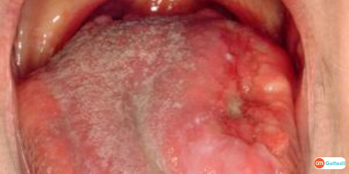 Mouth Cancer Treatment In India, Mouth Cancer Diagnosis, Tests to undergo for Mouth Cancer, Stages of mouth cancer, mouth cancer treatment cost in India, mouth cancer treatment in Delhi, mouth cancer symptoms