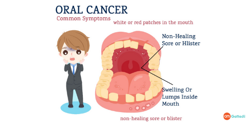 Mouth Cancer Treatment In India, Mouth Cancer Diagnosis, Tests to undergo for Mouth Cancer, Stages of mouth cancer, mouth cancer treatment cost in India, mouth cancer treatment in Delhi, mouth cancer symptoms