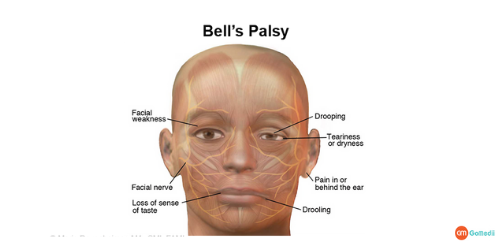 Facial Paralysis Treatment in Hyderabad, Facial Paralysis Surgery Cost In India, Hospitals For Paralysis Treatment in Hyderabad, Diagnose The Facial Paralysis, Risk To Develop Facial Paralysis, Treatment For Facial Paralysis, Medical Treatment Journey With GoMedii Facial Paralysis Treatment in Hyderabad, Facial Paralysis Surgery Cost In India, Hospitals For Paralysis Treatment in Hyderabad, Diagnose The Facial Paralysis, Risk To Develop Facial Paralysis, Treatment For Facial Paralysis, Medical Treatment Journey With GoMedii