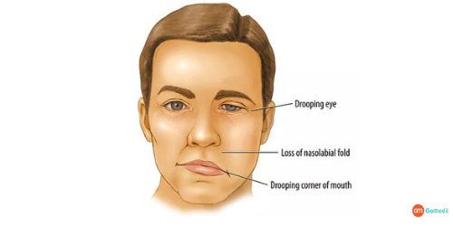 Facial Paralysis Treatment in Hyderabad, Facial Paralysis Surgery Cost In India, Hospitals For Paralysis Treatment in Hyderabad, Diagnose The Facial Paralysis, Risk To Develop Facial Paralysis, Treatment For Facial Paralysis, Medical Treatment Journey With GoMedii Facial Paralysis Treatment in Hyderabad, Facial Paralysis Surgery Cost In India, Hospitals For Paralysis Treatment in Hyderabad, Diagnose The Facial Paralysis, Risk To Develop Facial Paralysis, Treatment For Facial Paralysis, Medical Treatment Journey With GoMedii