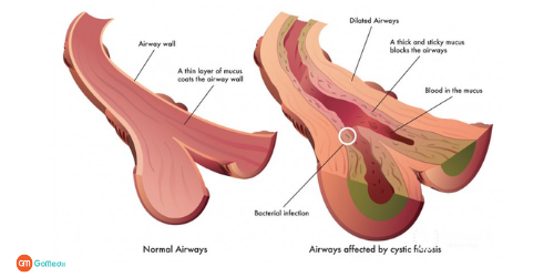 Cystic Fibrosis Treatment In Delhi NCR, Bowel Surgery In Delhi NCR, Lung transplant In Delhi NCR, Liver transplant In Delhi NCR, prevention of cystic fibrosis, cystic fibrosis symptoms, cystic fibrosis causes Cystic Fibrosis Treatment In Delhi NCR, Bowel Surgery In Delhi NCR, Lung transplant In Delhi NCR, Liver transplant In Delhi NCR, prevention of cystic fibrosis, cystic fibrosis symptoms, cystic fibrosis causes
