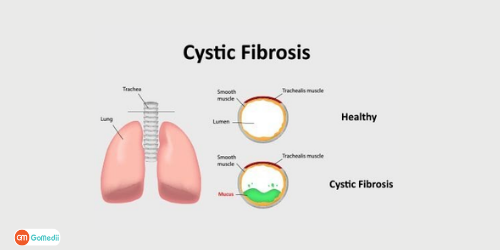 Cystic Fibrosis Treatment In Delhi NCR, Bowel Surgery In Delhi NCR, Lung transplant In Delhi NCR, Liver transplant In Delhi NCR, prevention of cystic fibrosis, cystic fibrosis symptoms, cystic fibrosis causes Cystic Fibrosis Treatment In Delhi NCR, Bowel Surgery In Delhi NCR, Lung transplant In Delhi NCR, Liver transplant In Delhi NCR, prevention of cystic fibrosis, cystic fibrosis symptoms, cystic fibrosis causes