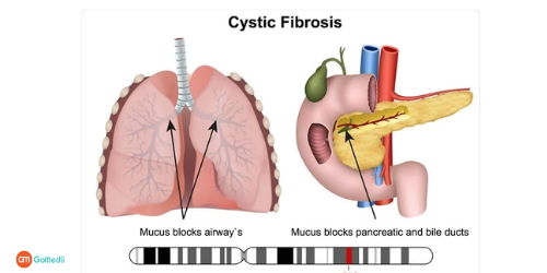 Cystic Fibrosis Treatment In Delhi NCR, Bowel Surgery In Delhi NCR, Lung transplant In Delhi NCR, Liver transplant In Delhi NCR, prevention of cystic fibrosis, cystic fibrosis symptoms, cystic fibrosis causes Cystic Fibrosis Treatment In Delhi NCR, Bowel Surgery In Delhi NCR, Lung transplant In Delhi NCR, Liver transplant In Delhi NCR, prevention of cystic fibrosis, cystic fibrosis symptoms, cystic fibrosis causes