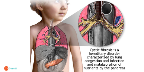 Cystic Fibrosis Treatment In Delhi NCR, Bowel Surgery In Delhi NCR, Lung transplant In Delhi NCR, Liver transplant In Delhi NCR, prevention of cystic fibrosis, cystic fibrosis symptoms, cystic fibrosis causes Cystic Fibrosis Treatment In Delhi NCR, Bowel Surgery In Delhi NCR, Lung transplant In Delhi NCR, Liver transplant In Delhi NCR, prevention of cystic fibrosis, cystic fibrosis symptoms, cystic fibrosis causes