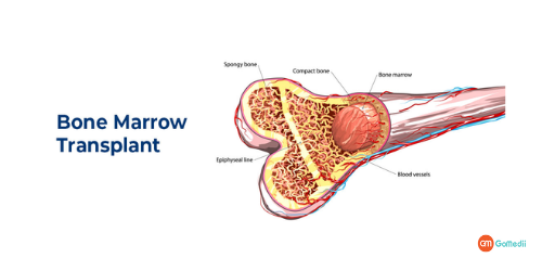 Stem Cell Bone Marrow Transplant in India, Bone Marrow Transplant, Human Leukocyte Antigen, types of Stemcell transplants, CNV infection, success rate of Bone Marrow Transplant in India, success rate of Stem cell Transplants in india Stem Cell Bone Marrow Transplant in India, Bone Marrow Transplant, Human Leukocyte Antigen, types of Stemcell transplants, CNV infection, success rate of Bone Marrow Transplant in India, success rate of Stem cell Transplants in india