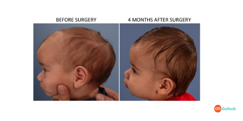 Low-Cost Craniosynostosis Treatment In India, Craniosynostosis treatment in india, craniosynostosis causes, Craniosynostosis Symptoms, craniosynostosis types, Cost of Craniosynostosis Treatment In India
