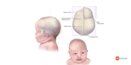 Low-Cost Craniosynostosis Treatment In India, Craniosynostosis treatment in india, craniosynostosis causes, Craniosynostosis Symptoms, craniosynostosis types, Cost of Craniosynostosis Treatment In India