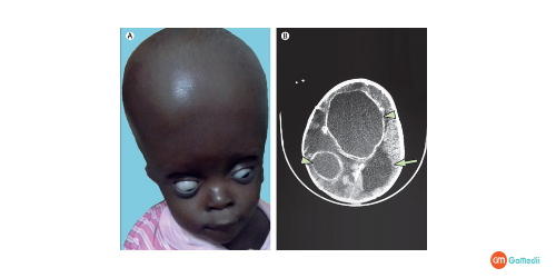 Brain Abscess Treatment in Thailand, Brain Abscess causes, Brain Abscess Signs, Brain Abscess Symptoms, Brain Abscess diagnosis, brain abscess recovery period Brain Abscess Treatment in Thailand, Brain Abscess causes, Brain Abscess Signs, Brain Abscess Symptoms, Brain Abscess diagnosis, brain abscess recovery period