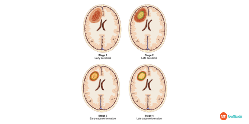 Brain Abscess Treatment in Thailand, Brain Abscess causes, Brain Abscess Signs, Brain Abscess Symptoms, Brain Abscess diagnosis, brain abscess recovery period Brain Abscess Treatment in Thailand, Brain Abscess causes, Brain Abscess Signs, Brain Abscess Symptoms, Brain Abscess diagnosis, brain abscess recovery period