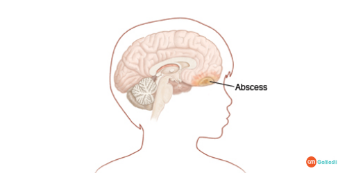 Brain Abscess Treatment in Thailand, Brain Abscess causes, Brain Abscess Signs, Brain Abscess Symptoms, Brain Abscess diagnosis, brain abscess recovery period Brain Abscess Treatment in Thailand, Brain Abscess causes, Brain Abscess Signs, Brain Abscess Symptoms, Brain Abscess diagnosis, brain abscess recovery period