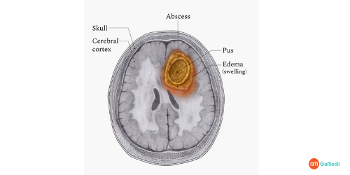 Brain Abscess Treatment in Thailand, Brain Abscess causes, Brain Abscess Signs, Brain Abscess Symptoms, Brain Abscess diagnosis, brain abscess recovery period Brain Abscess Treatment in Thailand, Brain Abscess causes, Brain Abscess Signs, Brain Abscess Symptoms, Brain Abscess diagnosis, brain abscess recovery period