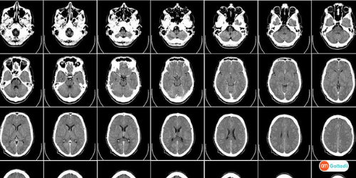 Focal Cortical Dysplasia Treatment In India, Options For Focal Cortical Dysplasia Treatment, Hospitals For Treatment Of Focal Cortical Dysplasia In India, Cost Of Focal Cortical Dysplasia In India, Symptoms Of Focal Cortical Dysplasia, Types Of Focal cortical dysplasia, Causes Of Focal Cortical Dysplasia, Focal Cortical Dysplasia Diagnosed