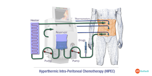 HIPEC Surgery In India, Hyperthermic Intraperitoneal Chemotherapy, discharged after a HIPEC Surgery, HIPEC surgery for ovarian cancer, HIPEC surgery in India Cost, Best HIPEC surgeons in IndiaHIPEC surgery success rate, Best hospital for HIPEC Surgery in india