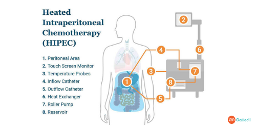 HIPEC Surgery In India, Hyperthermic Intraperitoneal Chemotherapy, discharged after a HIPEC Surgery, HIPEC surgery for ovarian cancer, HIPEC surgery in India Cost, Best HIPEC surgeons in IndiaHIPEC surgery success rate, Best hospital for HIPEC Surgery in india