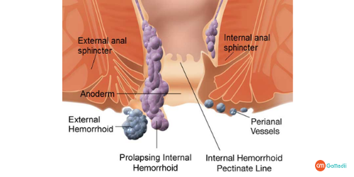 Hemorrhoids Treatment in Fortis Noida, Hemorrhoids Treatment in Noida, types of Hemorrhoids, Thrombosed hemorrhoids, hemorrhoid symptoms, External hemorrhoids, Internal hemorrhoids, Thrombosed hemorrhoids, internal hemorrhoid treatment, laser treatment for hemorrhoids