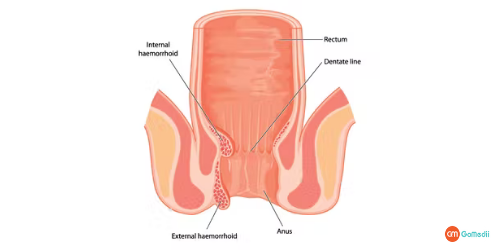 Hemorrhoids Treatment in Fortis Noida, Hemorrhoids Treatment in Noida, types of Hemorrhoids, Thrombosed hemorrhoids, hemorrhoid symptoms, External hemorrhoids, Internal hemorrhoids, Thrombosed hemorrhoids, internal hemorrhoid treatment, laser treatment for hemorrhoids