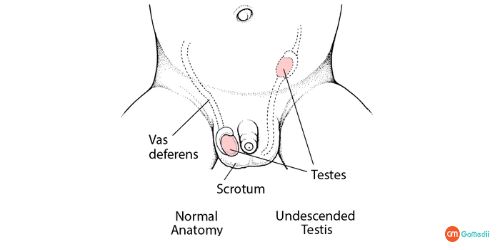 Undescended testicle Treatment In Delhi, symptoms of an Undescended testicle, testicle disappear, effects of an undescended testicle, cause an undescended testicle, diagnosis undescended testicles, testicles associated with infertility, Hospitals for the Undescended testicle Treatment In Delhi, Undescended Testicle Treatment In Delhi With GoMedii