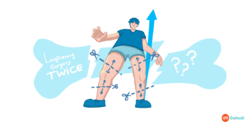 Leg Lengthening Surgery In India, leg-lengthening surgery, purpose of Leg lengthening surgery, leg-lengthening surgery hurt, Advantages of height increase through the surgery, cost of Leg lengthening surgery in India, Hospitals For Leg lengthening surgery in India, GoMedii For Leg lengthening surgery in India