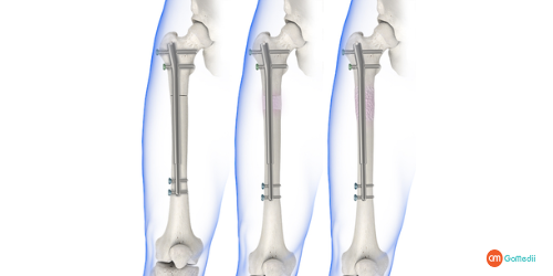 Leg Lengthening Surgery In India, leg-lengthening surgery, purpose of Leg lengthening surgery, leg-lengthening surgery hurt, Advantages of height increase through the surgery, cost of Leg lengthening surgery in India, Hospitals For Leg lengthening surgery in India, GoMedii For Leg lengthening surgery in India