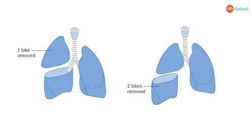 Lobectomy Treatment in India, Procedure for Lobectomy Treatment In India, Post-treatment care after Lobectomy Treatment In India, Hospitals for Lobectomy Treatment In India Lobectomy Treatment in India, Procedure for Lobectomy Treatment In India, Post-treatment care after Lobectomy Treatment In India, Hospitals for Lobectomy Treatment In India