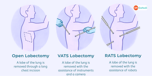 Lobectomy Treatment in India, Procedure for Lobectomy Treatment In India, Post-treatment care after Lobectomy Treatment In India, Hospitals for Lobectomy Treatment In India Lobectomy Treatment in India, Procedure for Lobectomy Treatment In India, Post-treatment care after Lobectomy Treatment In India, Hospitals for Lobectomy Treatment In India