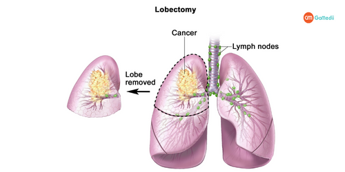 Lobectomy Treatment in India, Procedure for Lobectomy Treatment In India, Post-treatment care after Lobectomy Treatment In India, Hospitals for Lobectomy Treatment In India Lobectomy Treatment in India, Procedure for Lobectomy Treatment In India, Post-treatment care after Lobectomy Treatment In India, Hospitals for Lobectomy Treatment In India