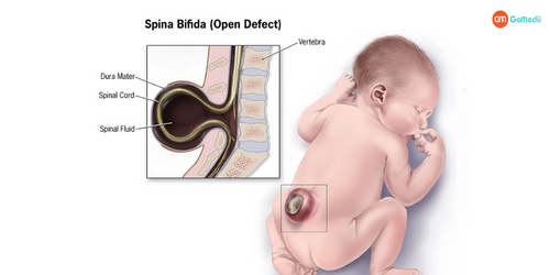Spina-Bifida.png