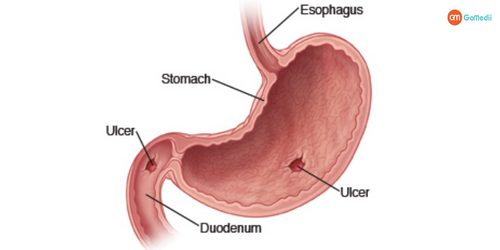 Peptic Ulcer Disease Treatment In India, home remedies for Peptic Ulcer Disease, symptoms of Peptic Ulcer Disease, diagnostics of Peptic Ulcer Disease Treatment, different types of peptide ulcers, cost of Peptic Ulcer Disease Treatment in India, Treatment for Peptic ulcer disease treatment