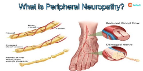 Peripheral Neuropathy Treatment in India, peripheral neuropathy, Symptoms of Peripheral Neuropathy, Cost for Peripheral Neuropathy Treatment in India, Hospitals for Peripheral Neuropathy treatment in India