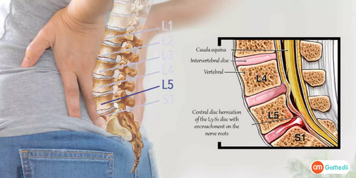Cost Of Surgical Treatments for L5-S1 In India, Options for Surgical Treatments for L5-S1, l5-s1 surgery success rate, Surgical Treatments for L5-S1