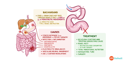 Adynamic Ileus Causes, Adynamic Ileus Treatments, Adynamic Ileus, symptoms OF Adynamic ileus, Cost of Adynamic ileus in India