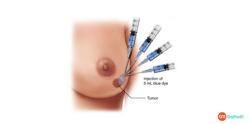 Sentinel Lymph Node, Breast Cancer, Sentinel lymph node biopsy, biopsy in breast cancer, Sentinel lymph node biopsy procedure, early-stage breast cancer Sentinel Lymph Node, Breast Cancer, Sentinel lymph node biopsy, biopsy in breast cancer, Sentinel lymph node biopsy procedure, early-stage breast cancer
