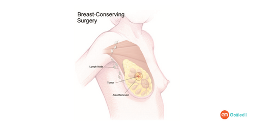 Lumpectomy Surgery in India, Lumpectomy Surgery Cost in india, recovery time after the Lumpectomy surgery, Lumpectomy Surgery Lumpectomy Surgery in India, Lumpectomy Surgery Cost in india, recovery time after the Lumpectomy surgery, Lumpectomy Surgery