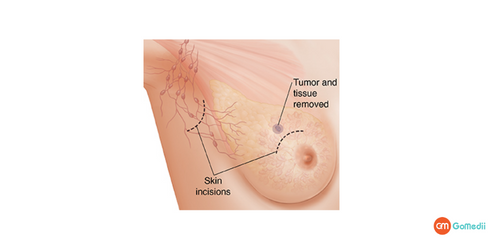 Lumpectomy Surgery in India, Lumpectomy Surgery Cost in india, recovery time after the Lumpectomy surgery, Lumpectomy Surgery Lumpectomy Surgery in India, Lumpectomy Surgery Cost in india, recovery time after the Lumpectomy surgery, Lumpectomy Surgery